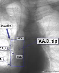 Patient at inspiration. V.A.D. above C.A.J. Example of why the box needs to be as long as it is.