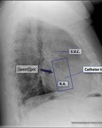 Lateral CXR Sweet Spot™