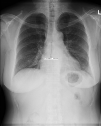 Often, the cavo-atrial junction can be approximated accurately as about 5 cm below the carina